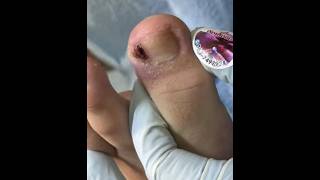 Ep_8469 Ingrown toenail removal 👣 เจ็บแป๊บเดียวดีกว่าเจ็บนานๆ 😄 (clip from Thailand)