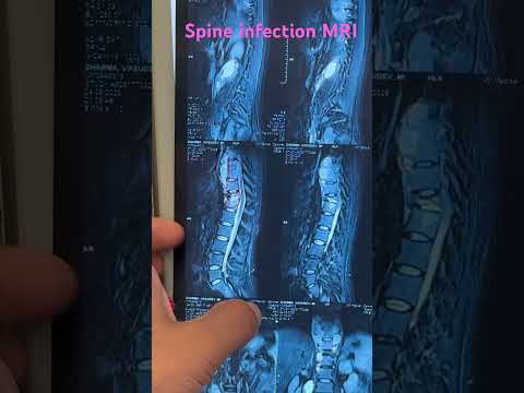 MRI findings in spinal TB( Tuberculosis )/ spinal infection #radiology #neuroscience #neurosurgeon