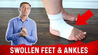 Foods for Fluid Retention in the Feet and Ankles