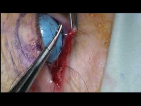 Cantoplastía lateral