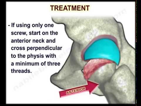 Slipped Capital Femoral Epiphysis - Everything You Need To Know - Dr. Nabil Ebraheim