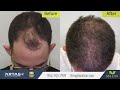 Seven months post-surgery hair transplant update on a patient of ours! Ft. Lauderdale FL