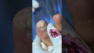 Ep_8153 Toenail removal 👣 เคยถอดเล็บมาแล้ว 2 ครั้งครับ 😄 (clip from Thailand)