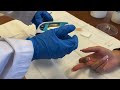 Capillary Puncture Finger Stick For Glucose Testing Medical Assistant