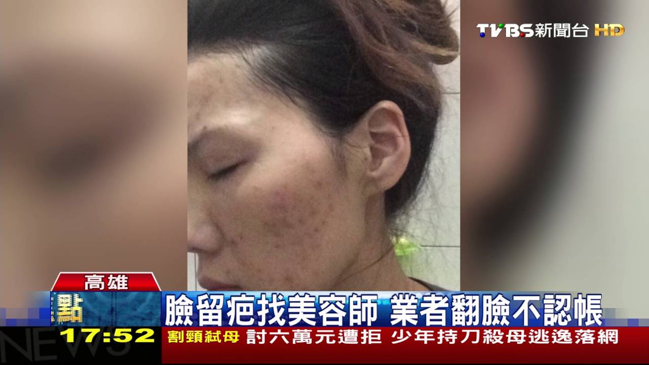 找無照美容師埋線 拉提無效反臉爛
