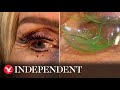 Doctor removes 23 contact lenses from patient’s eye