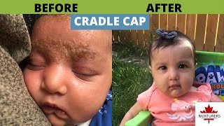 How to get rid of cradle cap and eczema | VLOG 10