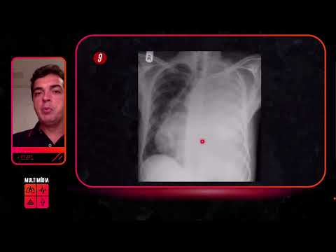 LIVE - Multimídia - Imagem nas Doenças Torácicas (INCLUINDO COVID-19)