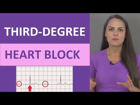 Third-Degree AV Heart Block ECG Nursing Rhythm NCLEX | Complete Heart Block
