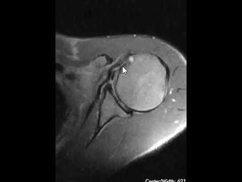 Biceps tendon dislocation and subscapularis tendon tear.