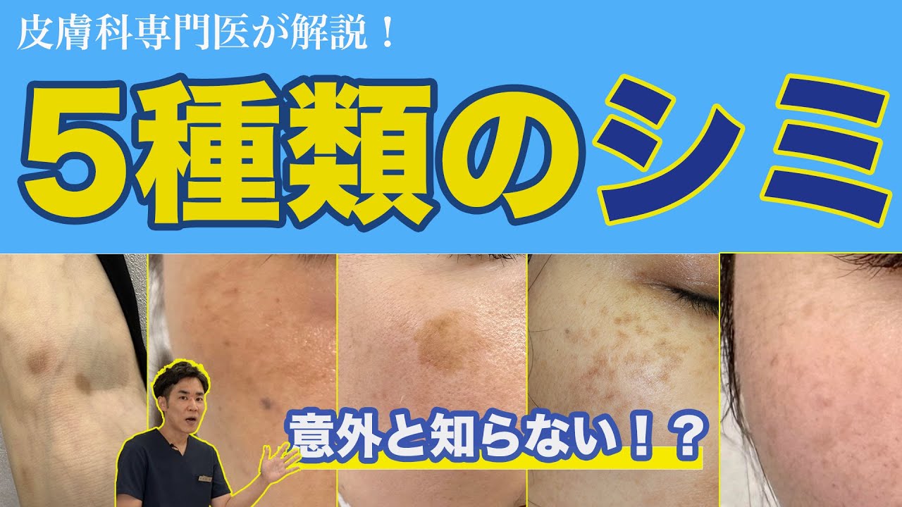 意外と知らないシミの種類