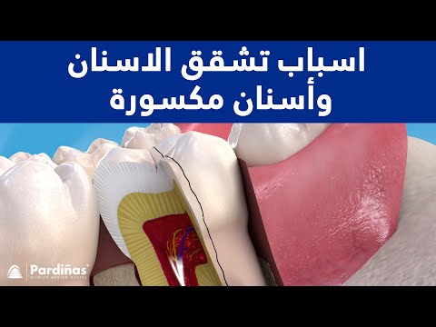 اسباب تشقق الاسنان وأسنان مكسورة