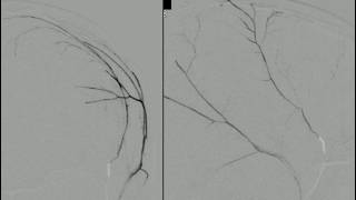 (English) Middle meningeal artery (MMA) embolization in cSDH