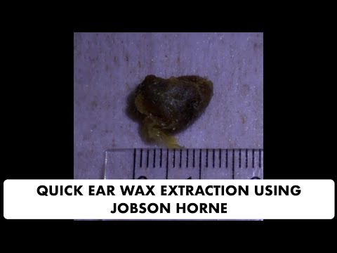 QUICK EAR WAX REMOVAL USING JOBSON HORNE - Ep 28