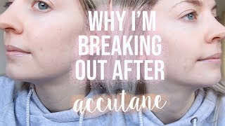 I’M BREAKING OUT AFTER ACCUTANE AND I THINK I KNOW WHY