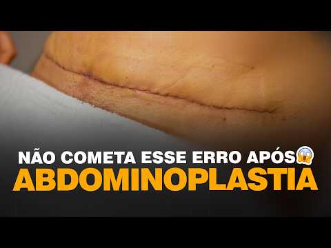 5 Serious Post-Abdominoplasty Mistakes | Plastic Surgery | Dr. Ícaro Samuel