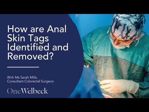 How are Anal Skin Tags Identified and Removed?