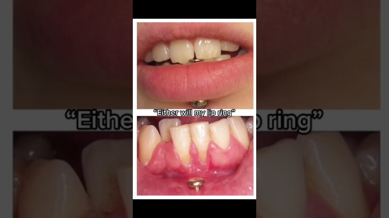 ⛔️ Dangers ⚠️ of oral piercings!