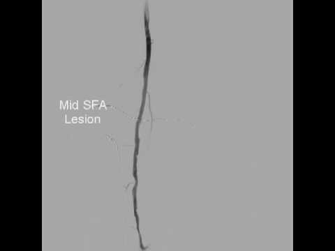 Left Mid SFA PTA and Stenting