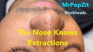 Nose extractions. Blackheads, whiteheads, milia.Keratin plugs extracted with deep squeeze. Pore dirt