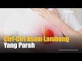 Jangan Diremehkan Ciri Ciri Asam Lambung Yang Parah