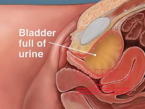 Catheterization Technique for the Urinary Bladder of a Female