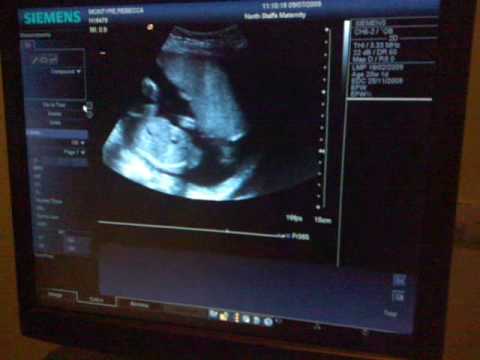 Baby 20 Week scan secret filming