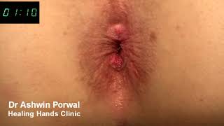 Laser Sphincterolysis for severe Anal Spasm | Cure for Anal Fissure | Dr Ashwin Porwal Healing Hands