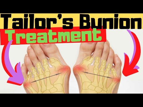 BEST 25 Plantar Fasciitis HOME Treatments Massage Stretches Shoes