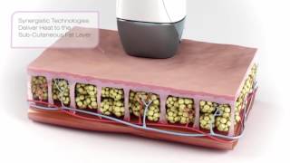 Dream Spa Medical- Velashape III in Brookline and Canton, MA