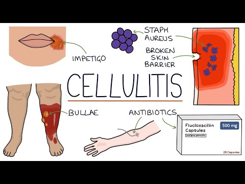 , title : 'Understanding Cellulitis: Skin and Soft Tissue Infections'