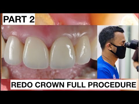 Step by Step Redo Dental Crown. Part 2