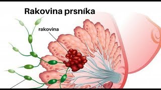 Prevencia pri rakovine prsníka je najdôležitejšia: správa v slovenskom posunkovom jazyku