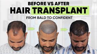 Hair Transplant in Delhi (HX-VEQF) | Best Results & Cost of Hair Transplant in Delhi