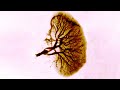A Woman Nibbled On A Burger Sitting On Her Desk For Days This Is What Happened To Her Kidneys
