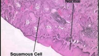Understanding Esophageal Cancer, Part I:  Introduction