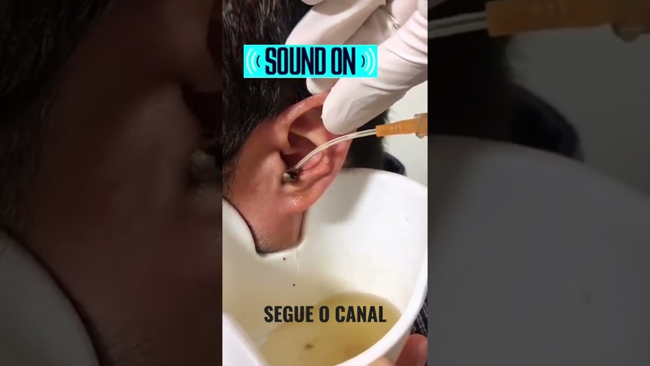Lavagem de Ouvido Bem Feita!!!