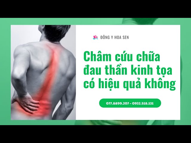 Các Huyệt Đạo Châm Cứu Chữa Đau Thần Kinh Tọa