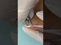 INGROWN TOENAIL Hack DIY Worked For Me