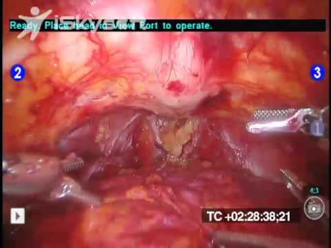 Creating Urethral Anastomosis Without Suturing
