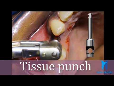 Flapless Implant Surgery Technique