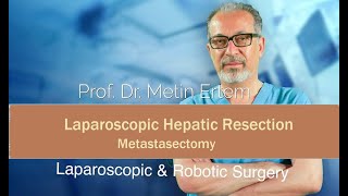 Miniaturka - Laparoscopic atypical hepatic resection.(metastasectomy). Metin Ertem MD FACS.