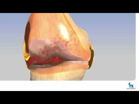 ízületi fájdalom a lábban mint a kezelésére mozgás a csípőízület ízületi gyulladása miatt