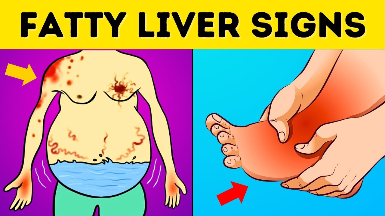 A Silent Threat: 8 Signs That Could Indicate Fatty Liver Disease | Healthy Care | (Liver Cirrhosis)