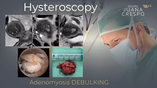 Hysteroscopic adenomyomectomy (Solid/Cystic)