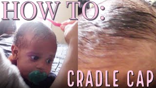HOW TO TREAT CRADLE CAP // 4 MONTHS OLD