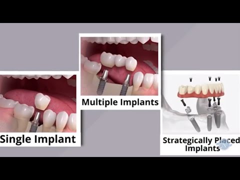 About dental implants