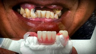 How to Combine a Denture and Flexible Partial for a Stellar Restoration for a Patient