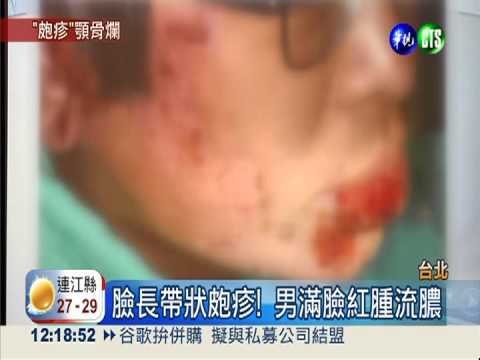 帶狀皰疹爛臉! 男子下顎骨險壞死