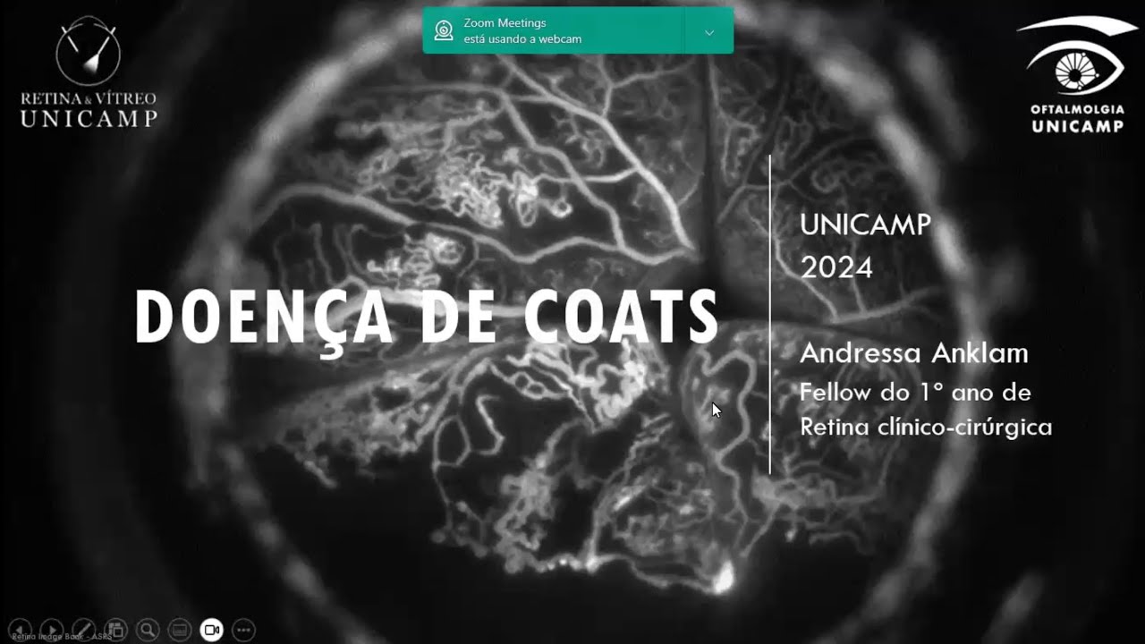 Retina e Vítreo (03/10/2024) - Doença de Coats